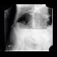 Sigmoid volvulus, ileus: X-ray - Plain radiograph